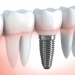 implantologia osteointegrata